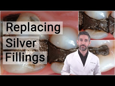 Replacing Silver Fillings with Biomimetic Dentistry | When, Why, and How to replace Amalgam