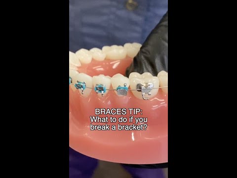 Broken Braces? Here