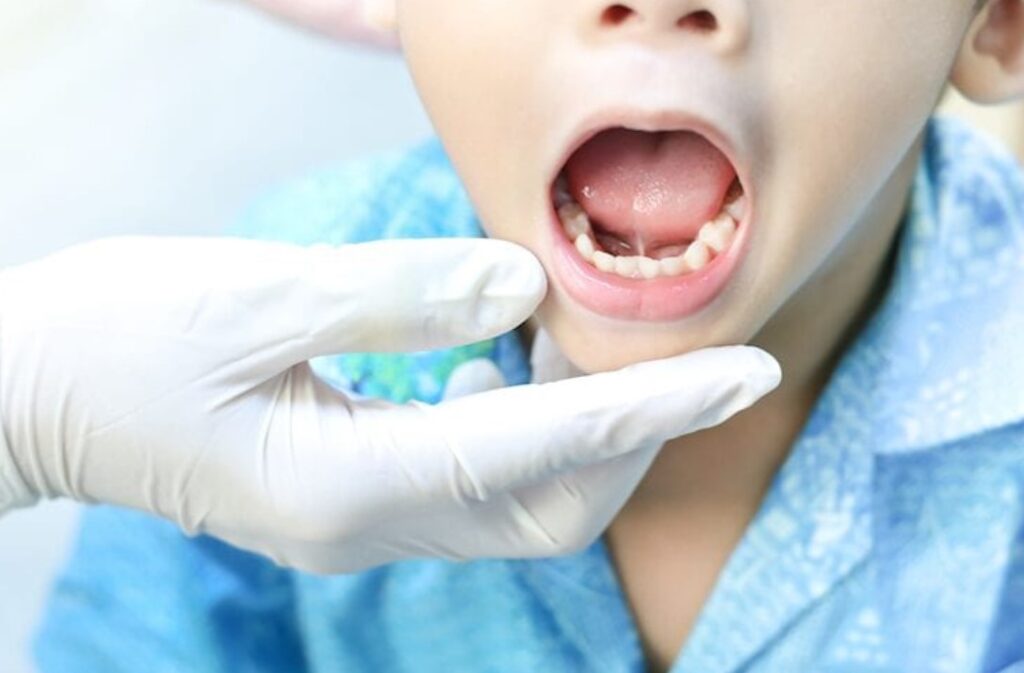 How Does a Frenectomy Procedure Impact Oral Health