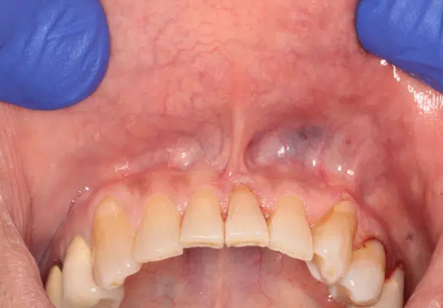 What Frenectomy VA Insurance Covers